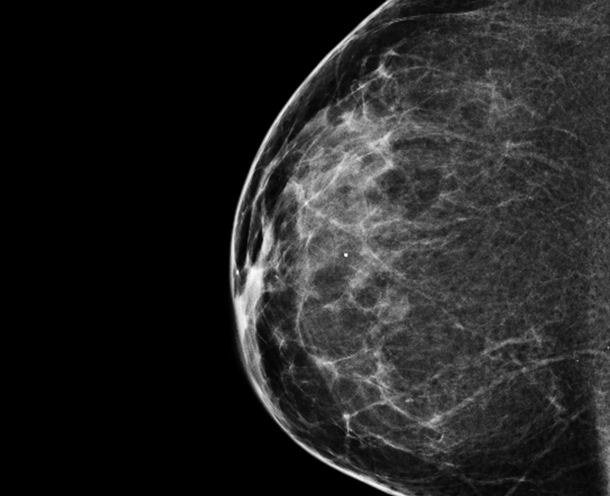Protected: The Mammogram Question